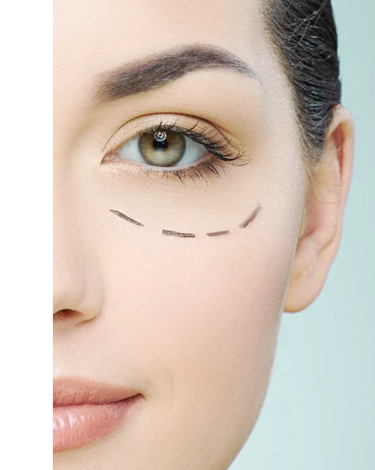 Blefaroplastia